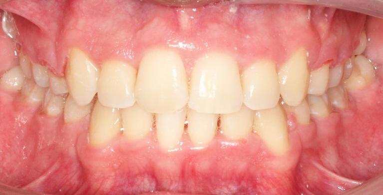 Braces for Kids in Santa Monica | Before & After