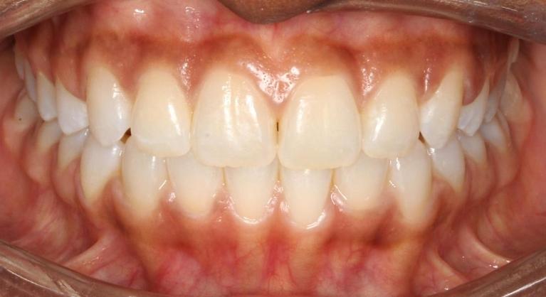 Adolescent Braces Smile Transformation | After