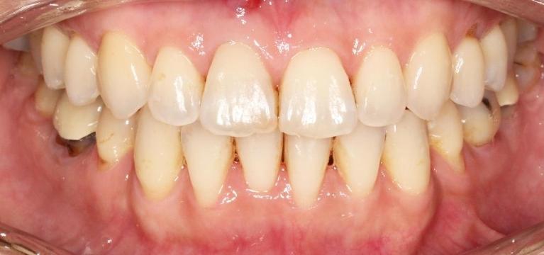Underbite Correction in Santa Monica | Before & After