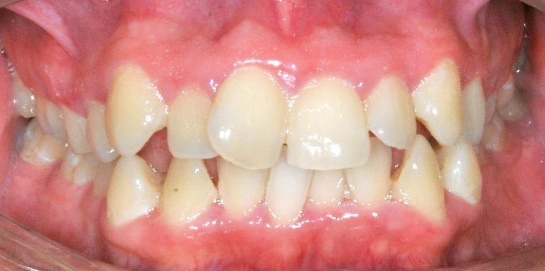 Braces for Kids in Santa Monica | Before & After
