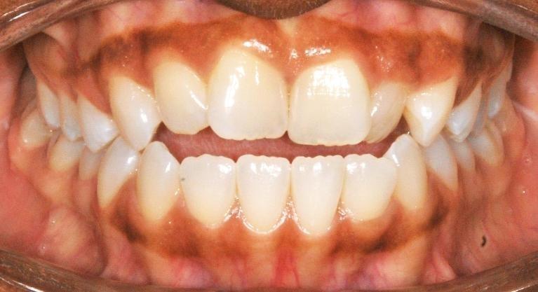 Adolescent Braces Smile Transformation | Before