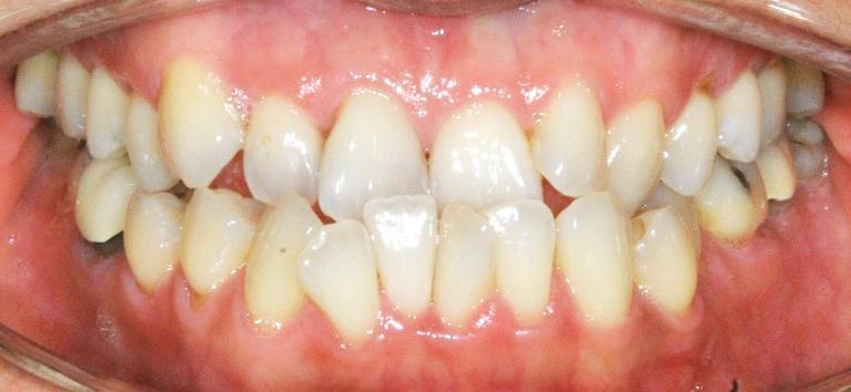 Underbite Correction in Santa Monica | Before & After